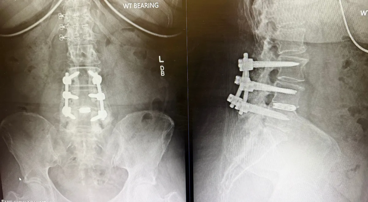 How do doctors check if a fusion healed?